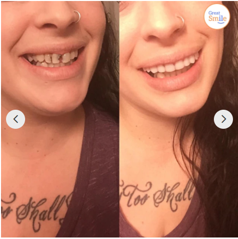 Snap-On Cosmetic Dental Veneers for Adults — Instant Smile Enhancement Solution for Everyday Confidence | Koossa