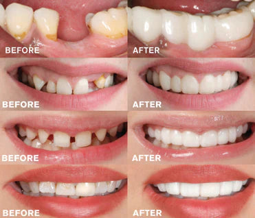 Snap-On Cosmetic Dental Veneers for Adults — Instant Smile Enhancement Solution for Everyday Confidence | Koossa