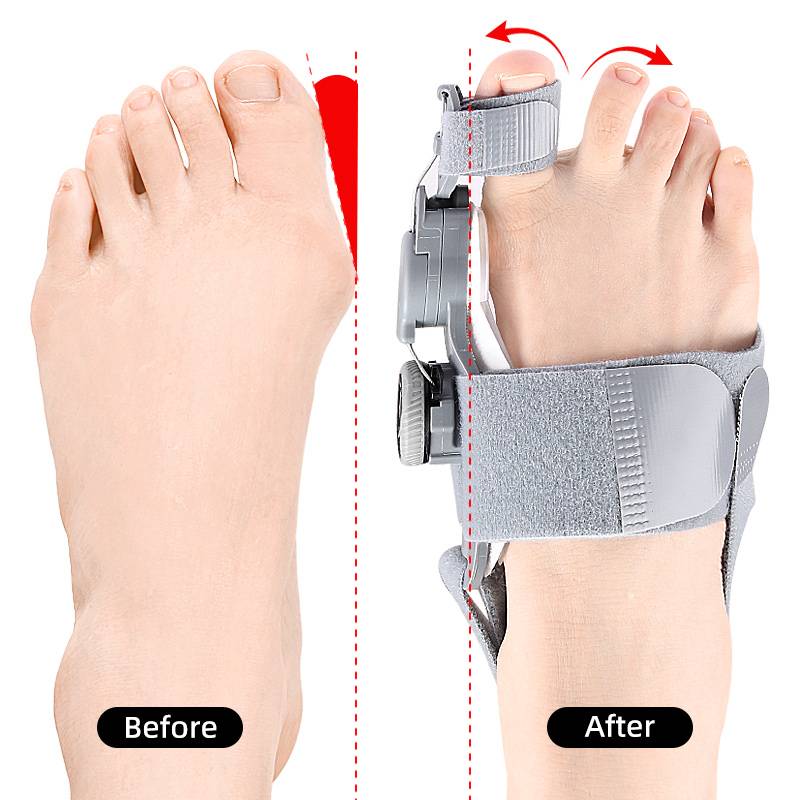 Adjustable Bunion Corrector for Big Toe Alignment with 3D Dial Control Day or Night Medical-Grade Silicone Hallux Valgus Splint | Lonoma