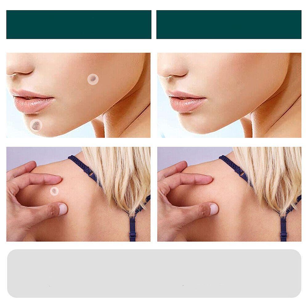 Hydrocolloid Skin Tag Patches 120-Count, Invisible Spot Patches with Tea Tree Oil for Face, Neck & Body, Gentle At-Home Skin Care | Lonoma
