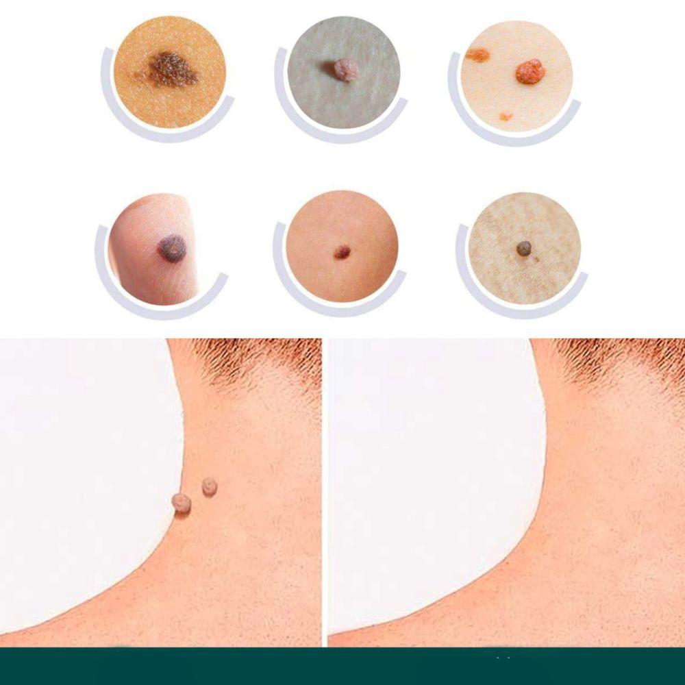 Hydrocolloid Skin Tag Patches 120-Count, Invisible Spot Patches with Tea Tree Oil for Face, Neck & Body, Gentle At-Home Skin Care | Lonoma