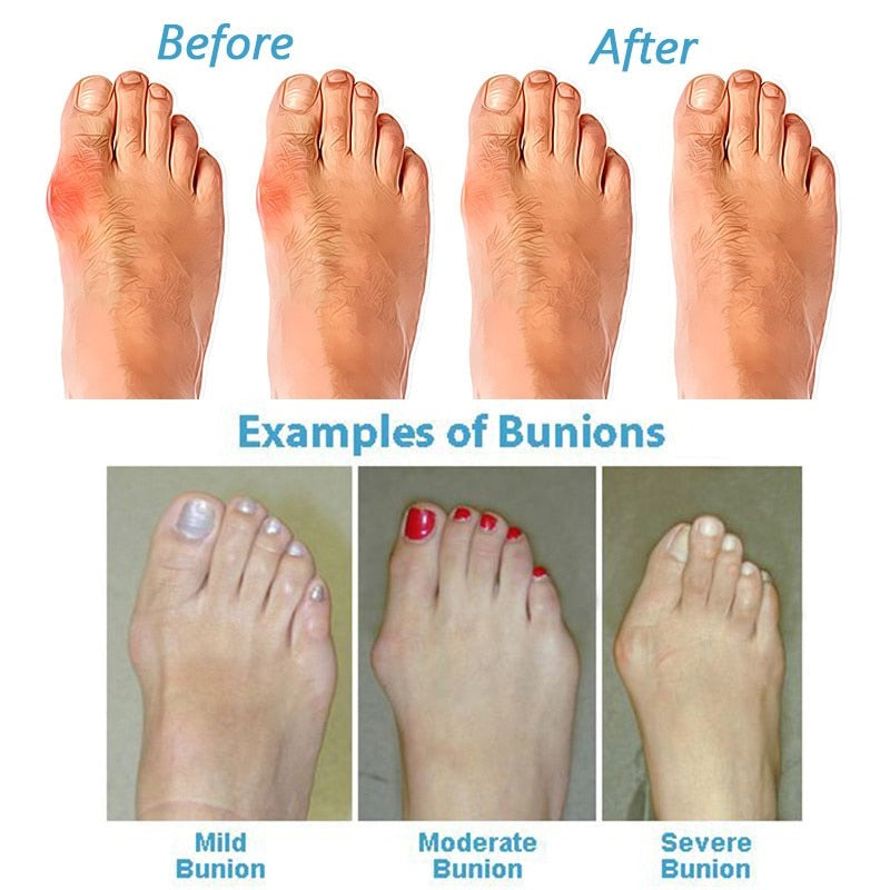Women's Orthopaedic Sandals for Bunions — Comfortable Summer Footwear with Arch Support & Posture Correction | Koossa