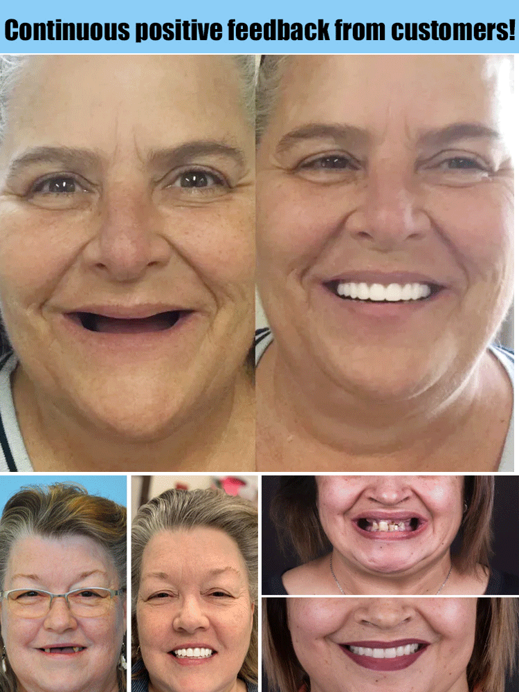 Moldable Cosmetic Denture Set Upper & Lower, Natural White Temporary Teeth, Heat-Fit Smile Cover for Photos and Events | Lonoma